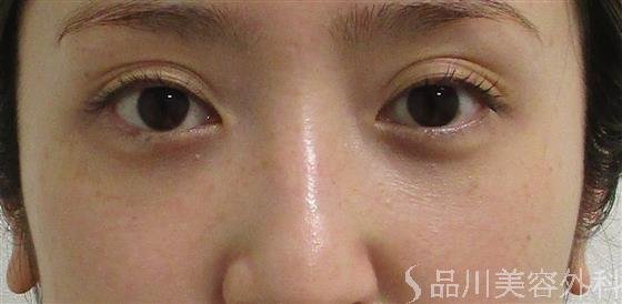 症例NO.55223のAFTER写真