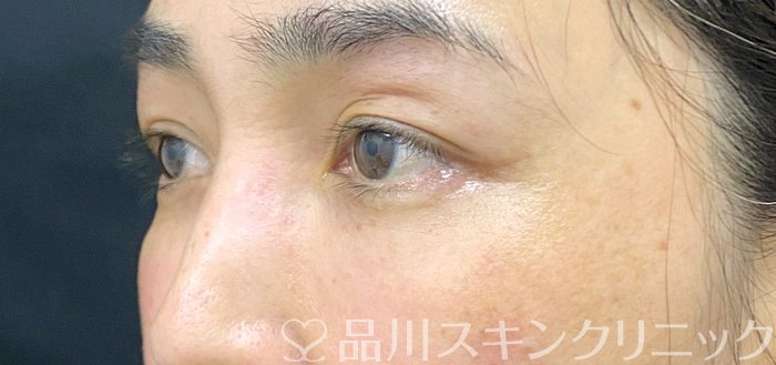 症例NO.75199のAFTER写真