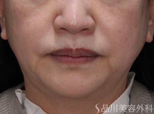 症例NO.69288のBEFORE写真