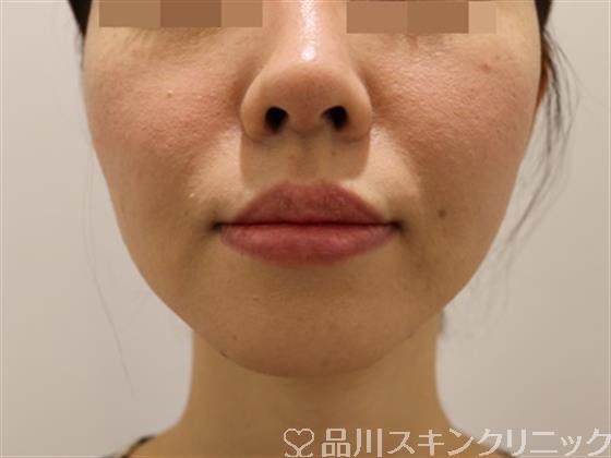 症例NO.43255のBEFORE写真