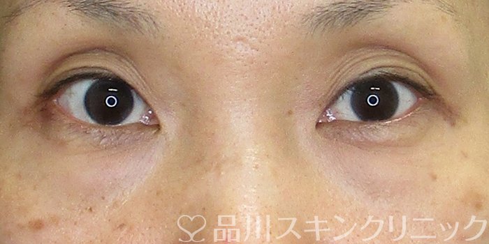 症例NO.74839のBEFORE写真