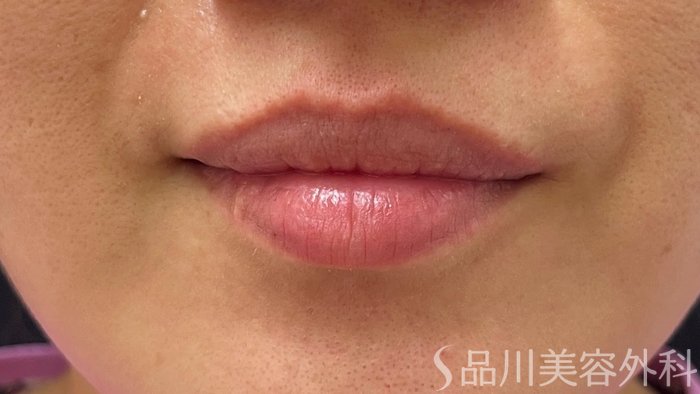 症例NO.70275のBEFORE写真