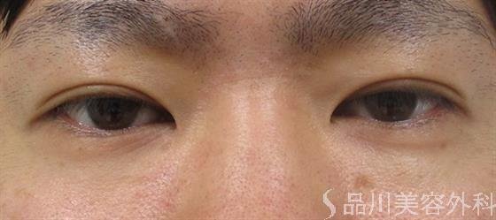 症例NO.41797のAFTER写真