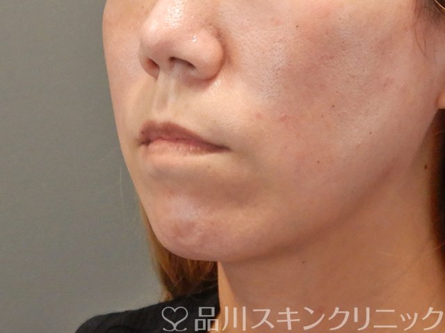 症例NO.75039のBEFORE写真