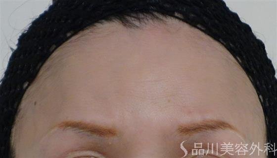 症例NO.51172のAFTER写真