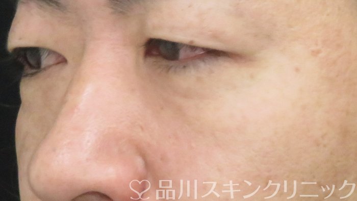 症例NO.70977のBEFORE写真