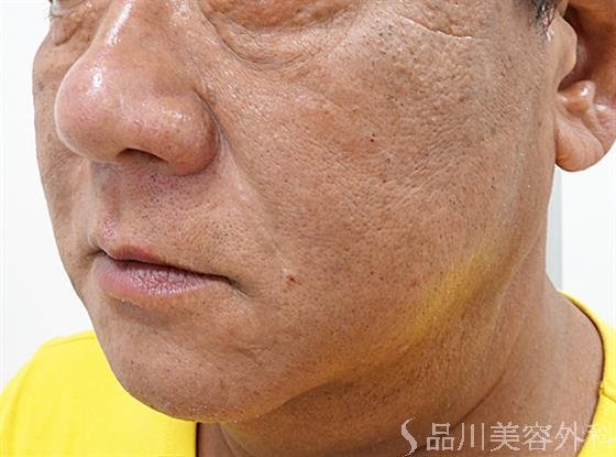 症例NO.55577のAFTER写真