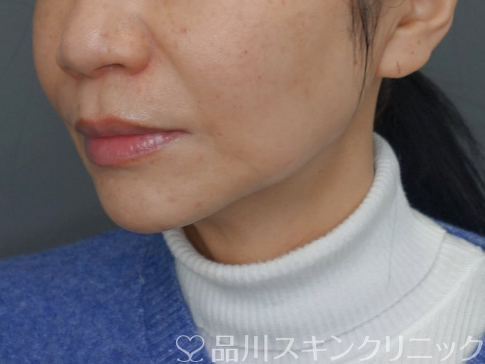 症例NO.72975のBEFORE写真