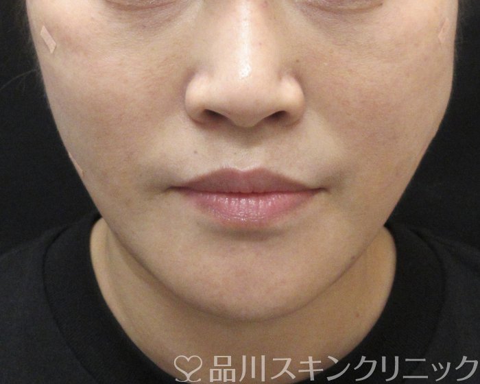 症例NO.69215のAFTER写真