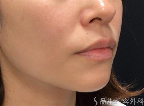 症例NO.59152のBEFORE写真