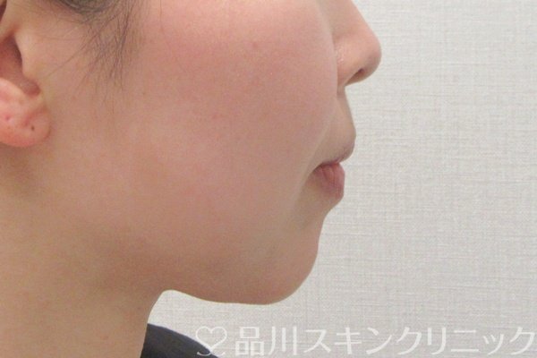 症例NO.74576のAFTER写真