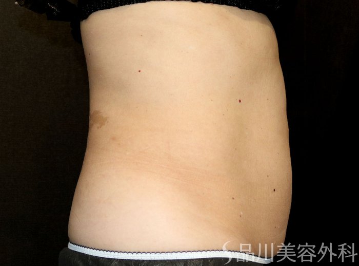 症例NO.74025のAFTER写真