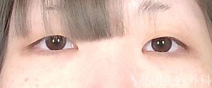 症例NO.65716のBEFORE写真