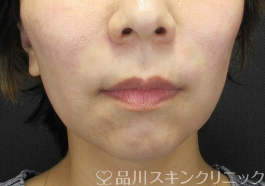 症例NO.69223のAFTER写真