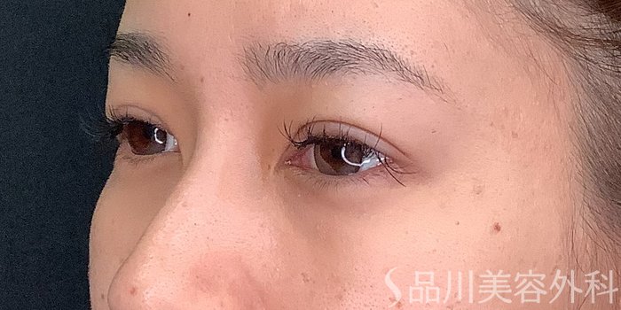 症例NO.71238のAFTER写真