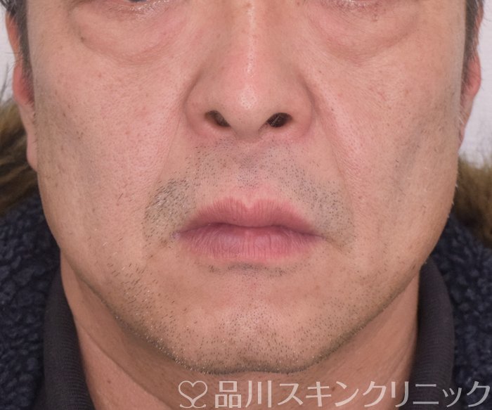 症例NO.65369のBEFORE写真