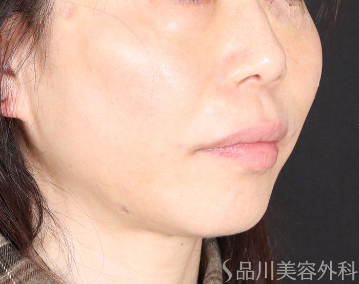 症例NO.72702のAFTER写真