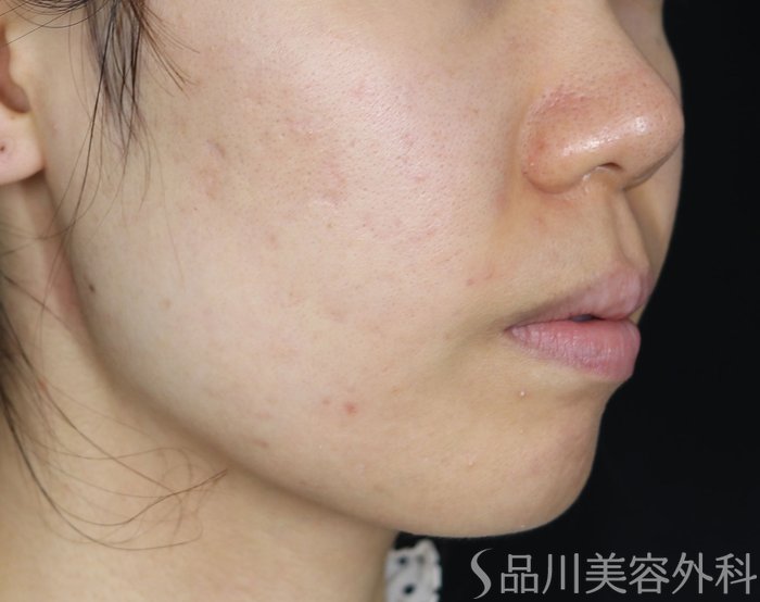 症例NO.71920のBEFORE写真