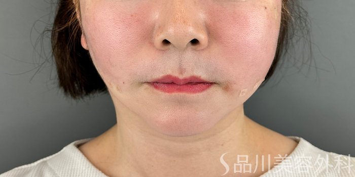 症例NO.70957のAFTER写真