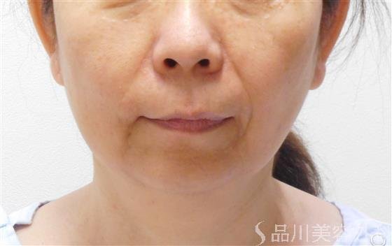 症例NO.44167のBEFORE写真