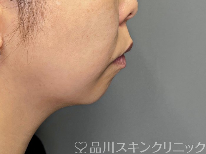 症例NO.65120のBEFORE写真