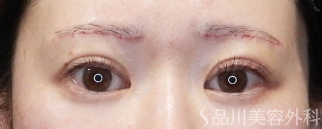 症例NO.73106のAFTER写真