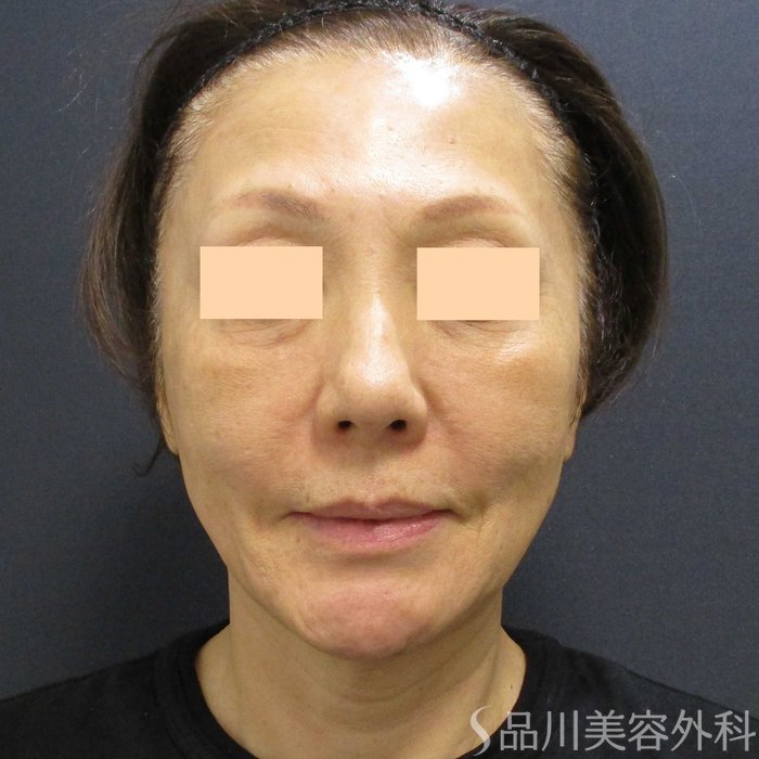 症例NO.70313のBEFORE写真