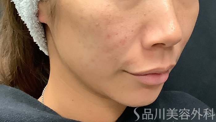 症例NO.67961のBEFORE写真