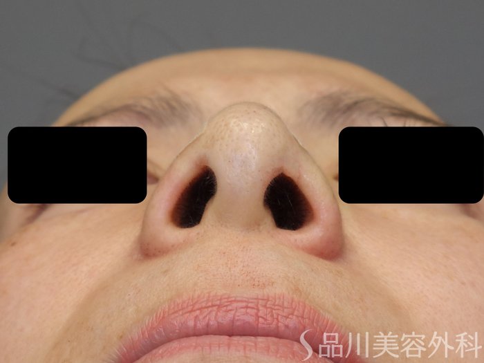 症例NO.72550のAFTER写真