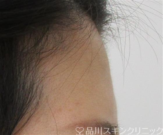 症例NO.42337のBEFORE写真