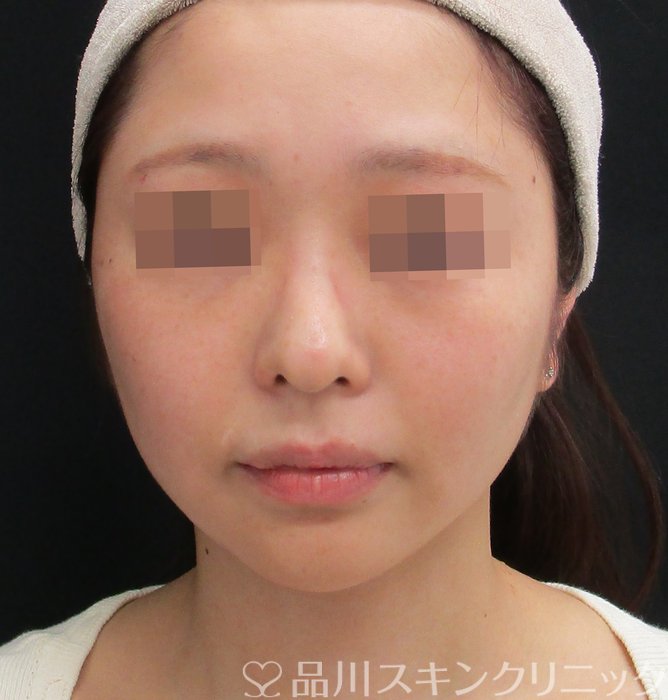 症例NO.74827のBEFORE写真