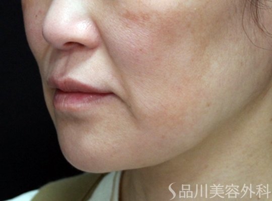 症例NO.73386のBEFORE写真