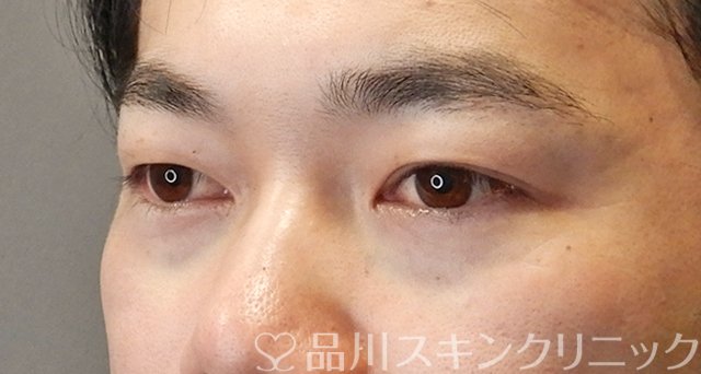 症例NO.66977のAFTER写真
