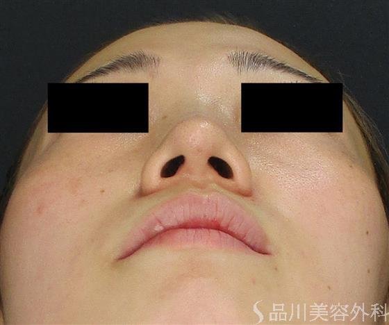 症例NO.61853のAFTER写真