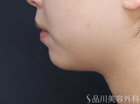 症例NO.71149のBEFORE写真