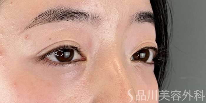 症例NO.72838のAFTER写真