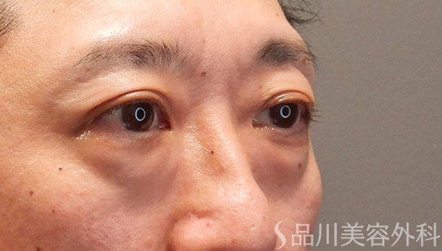 症例NO.75058のBEFORE写真