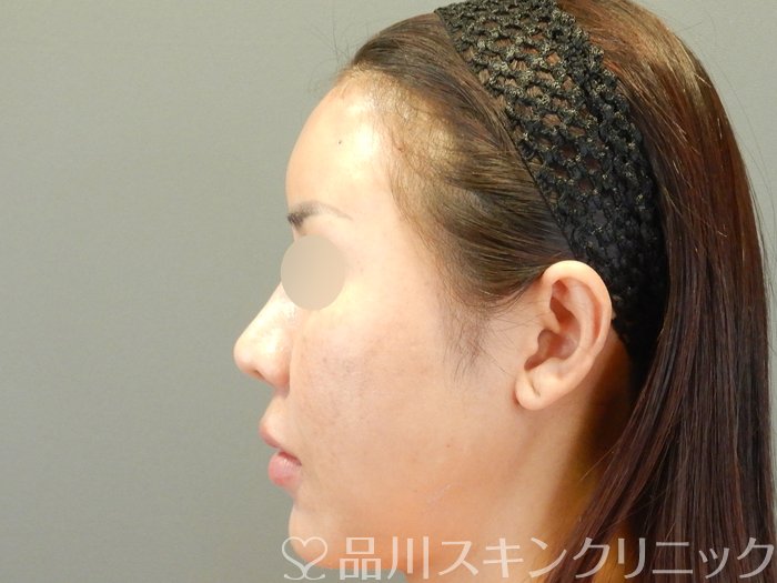 症例NO.65033のAFTER写真