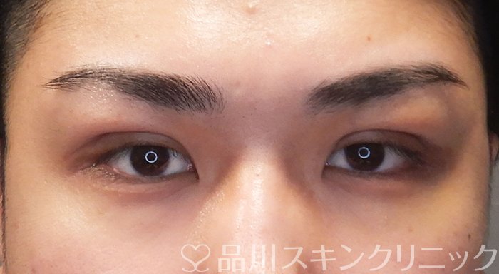 症例NO.69613のAFTER写真