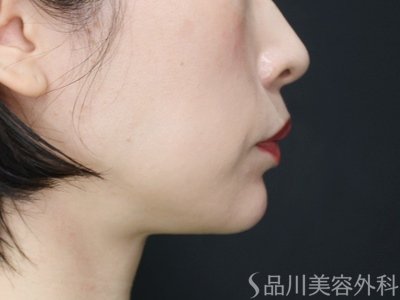 症例NO.74102のAFTER写真