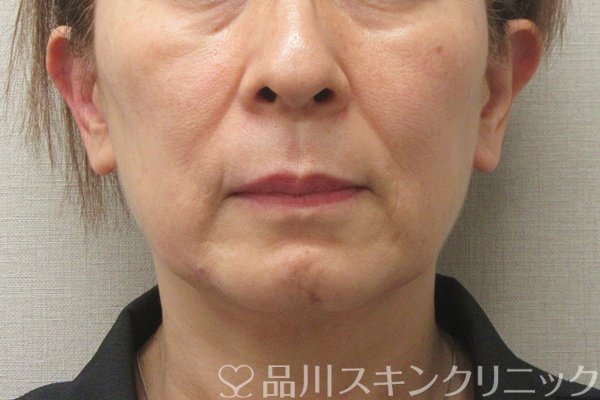 症例NO.74202のBEFORE写真