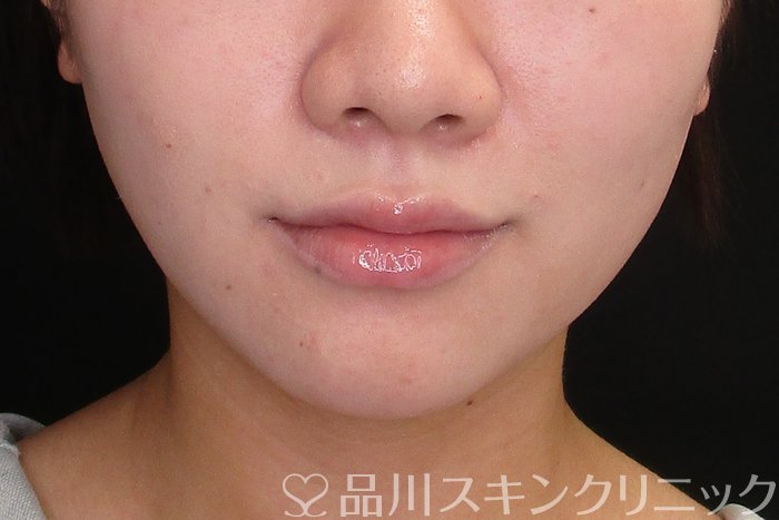 症例NO.74709のBEFORE写真