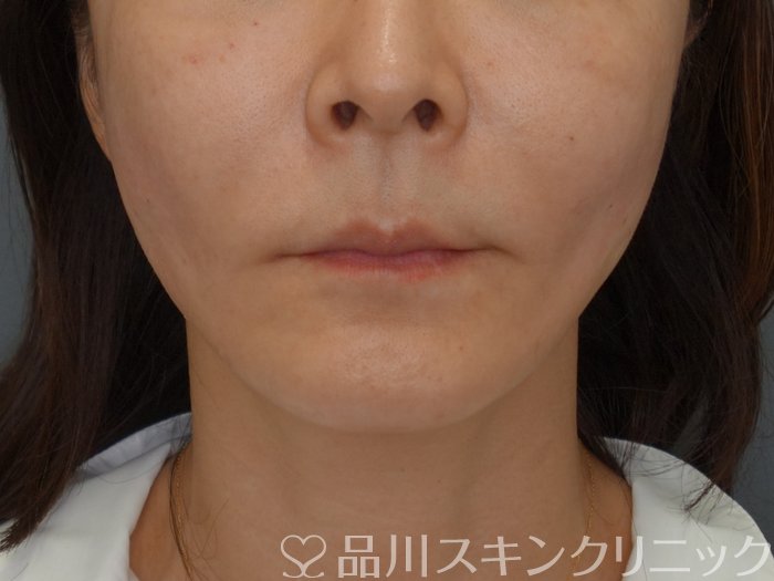 症例NO.71752のAFTER写真