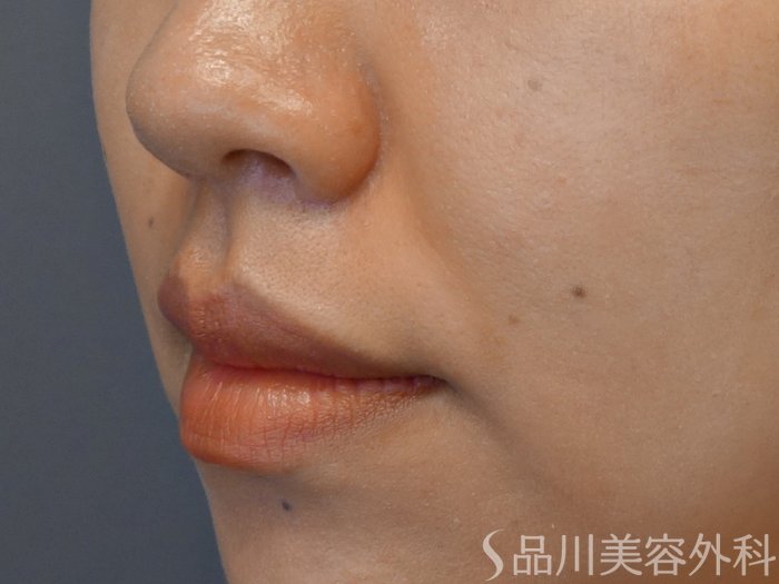 症例NO.69895のBEFORE写真