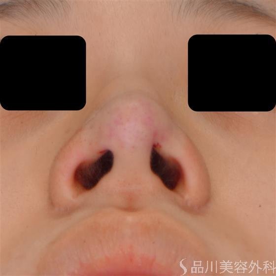 症例NO.54424のAFTER写真
