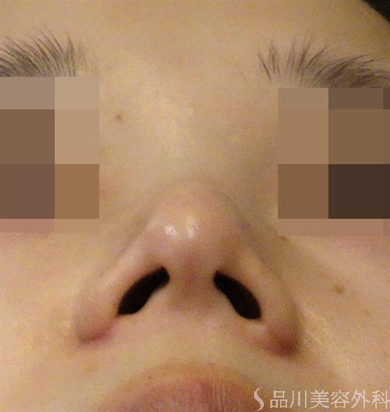 症例NO.40180のAFTER写真