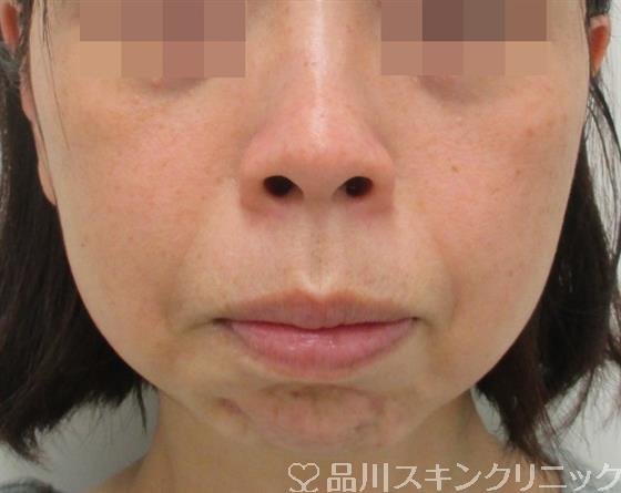 症例NO.27641のBEFORE写真