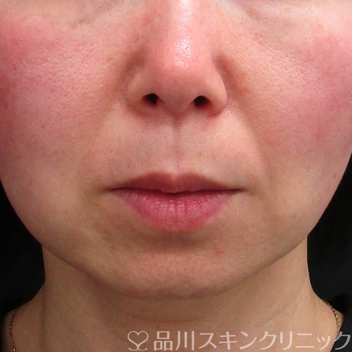 症例NO.70596のBEFORE写真