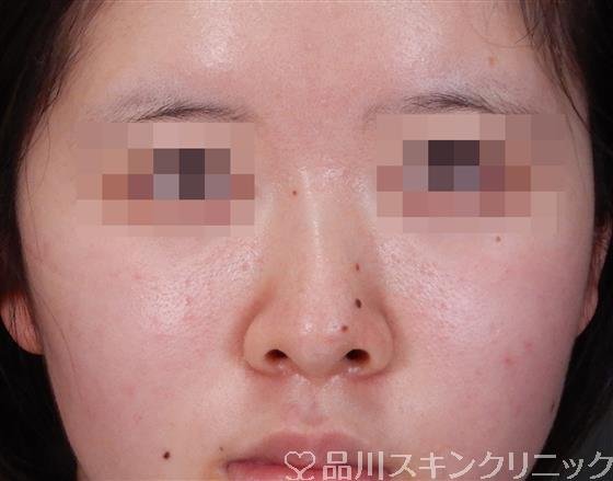 症例NO.55650のBEFORE写真