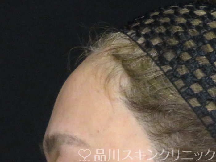症例NO.67971のBEFORE写真